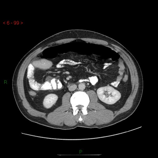Closed loop obstruction and appendicular stump mucocele (Radiopaedia 54014-60163 A 54).jpg