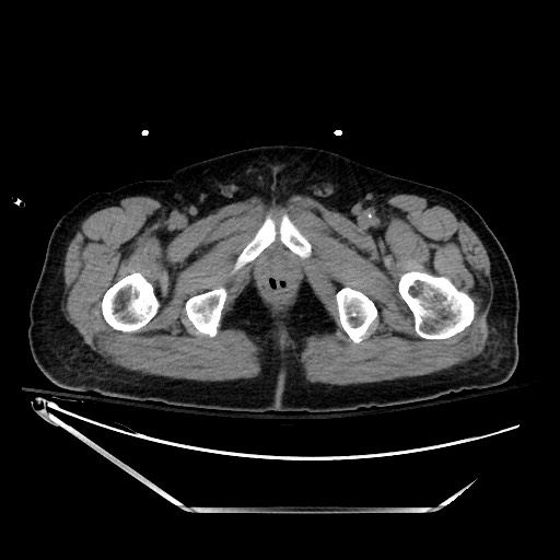 File:Closed loop obstruction due to adhesive band, resulting in small bowel ischemia and resection (Radiopaedia 83835-99023 Axial non-contrast 162).jpg
