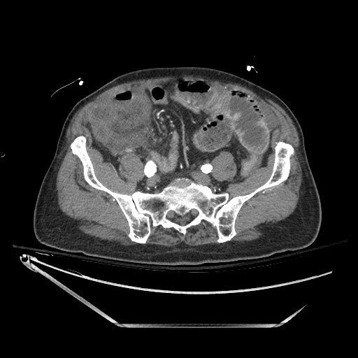Closed loop obstruction due to adhesive band, resulting in small bowel ischemia and resection (Radiopaedia 83835-99023 B 110).jpg