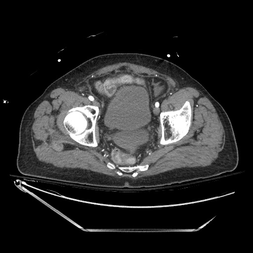 File:Closed loop obstruction due to adhesive band, resulting in small bowel ischemia and resection (Radiopaedia 83835-99023 B 138).jpg