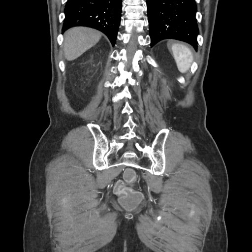 Closed loop obstruction due to adhesive band, resulting in small bowel ischemia and resection (Radiopaedia 83835-99023 C 100).jpg