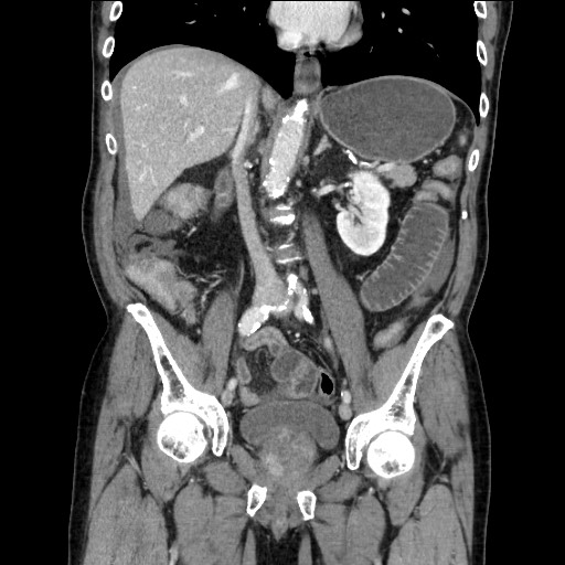 Closed loop obstruction due to adhesive band, resulting in small bowel ischemia and resection (Radiopaedia 83835-99023 E 70).jpg