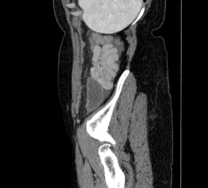 Closed loop small bowel obstruction (Radiopaedia 71211-81508 C 151).jpg