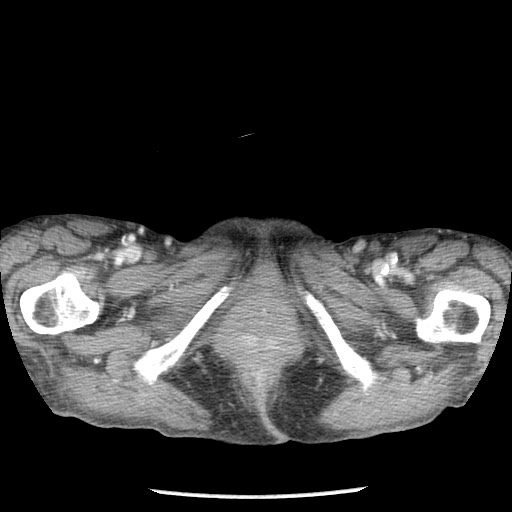 Closed loop small bowel obstruction - adhesions and infarct (Radiopaedia 85125-100678 B 119).jpg
