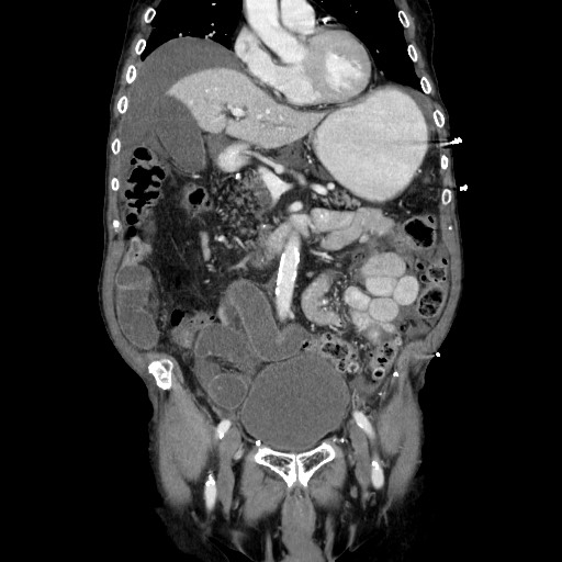 File:Closed loop small bowel obstruction - adhesive disease and hemorrhagic ischemia (Radiopaedia 86831-102990 B 54).jpg