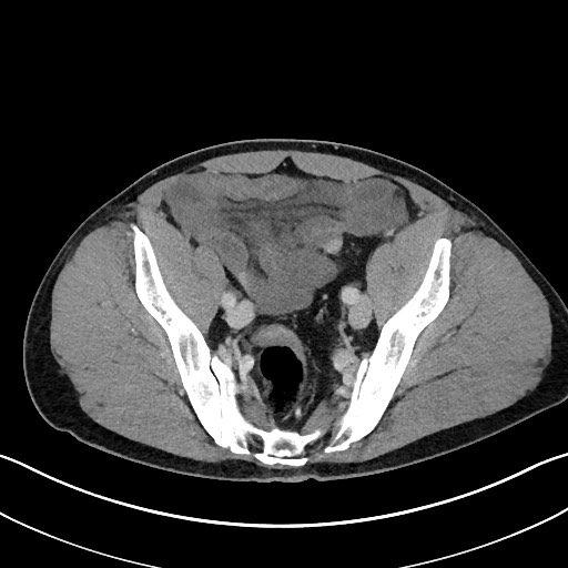 Closed loop small bowel obstruction - internal hernia (Radiopaedia 57806-64778 B 102).jpg