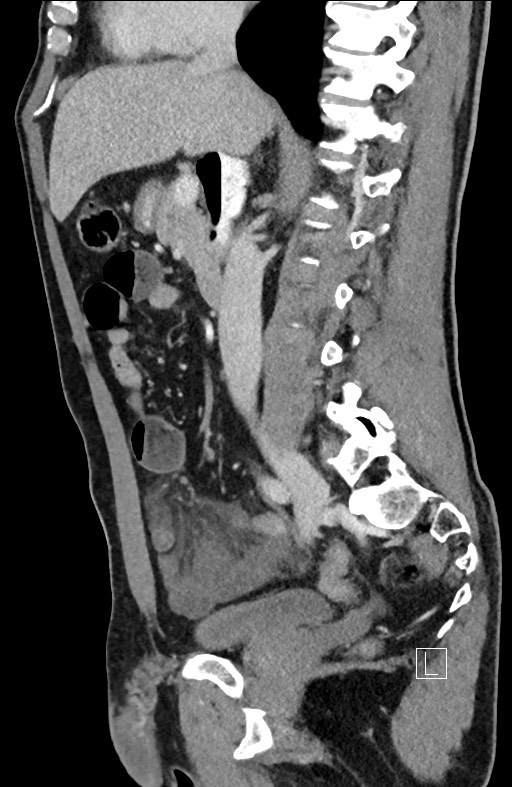 Closed loop small bowel obstruction - internal hernia (Radiopaedia 57806-64778 C 64).jpg