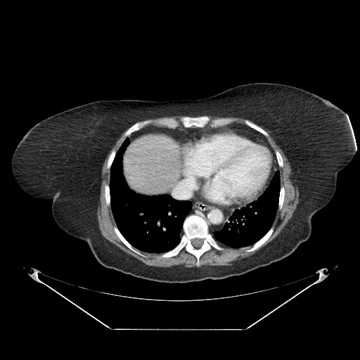 Closed loop small bowel obstruction - internal hernia (Radiopaedia 65402-74450 A 1).jpg