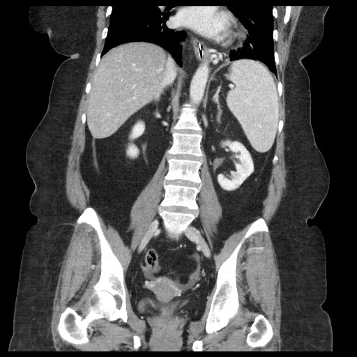 Closed loop small bowel obstruction - internal hernia (Radiopaedia 65402-74450 B 68).jpg