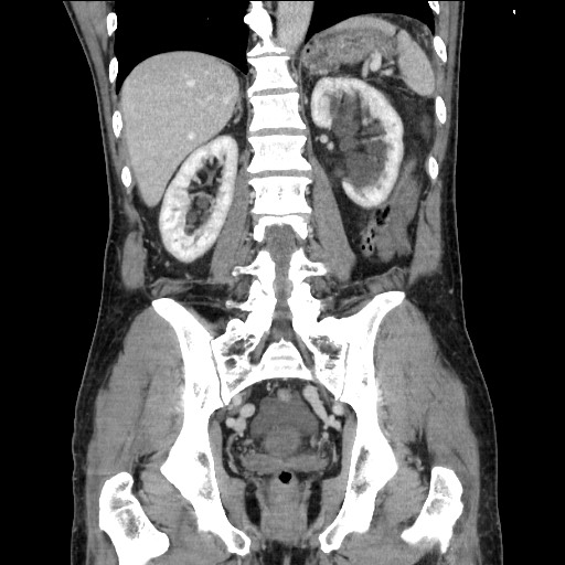 Closed loop small bowel obstruction - omental adhesion causing "internal hernia" (Radiopaedia 85129-100682 B 88).jpg