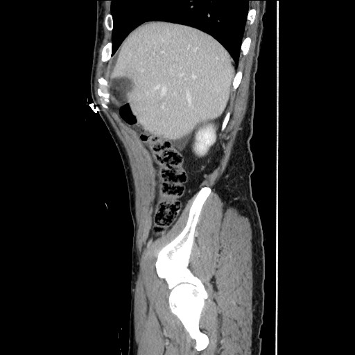 Closed loop small bowel obstruction - omental adhesion causing "internal hernia" (Radiopaedia 85129-100682 C 45).jpg