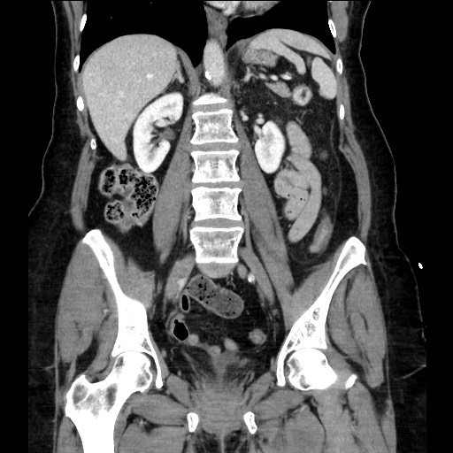 Closed loop small bowel obstruction due to adhesive bands - early and late images (Radiopaedia 83830-99014 B 75).jpg