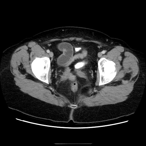 Closed loop small bowel obstruction due to adhesive bands - early and late images (Radiopaedia 83830-99015 A 154).jpg