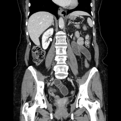 File:Closed loop small bowel obstruction due to adhesive bands - early and late images (Radiopaedia 83830-99015 B 75).jpg