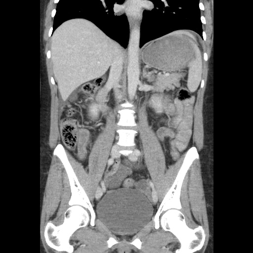 File:Closed loop small bowel obstruction due to trans-omental herniation (Radiopaedia 35593-37109 B 31).jpg