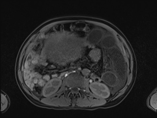 Closed loop small bowel obstruction in pregnancy (MRI) (Radiopaedia 87637-104031 Axial T1 fat sat 59).jpg