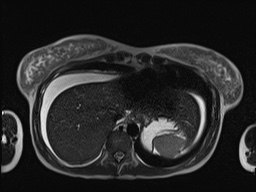 File:Closed loop small bowel obstruction in pregnancy (MRI) (Radiopaedia 87637-104031 Axial T2 10).jpg