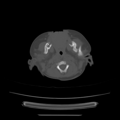 Cloverleaf skull (Radiopaedia 91901-109710 Axial bone window 33).jpg
