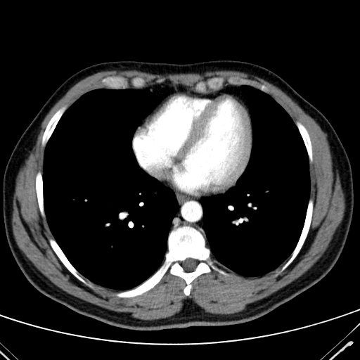 Codominant double aortic arch (Radiopaedia 56012-62637 A 41).jpg