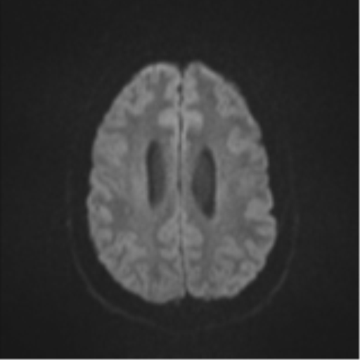 Colloid cyst (Radiopaedia 44510-48181 Axial DWI 48).png
