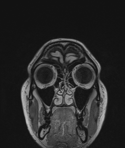 Colloid cyst (Radiopaedia 73154-83877 Coronal FLAIR 1).jpg