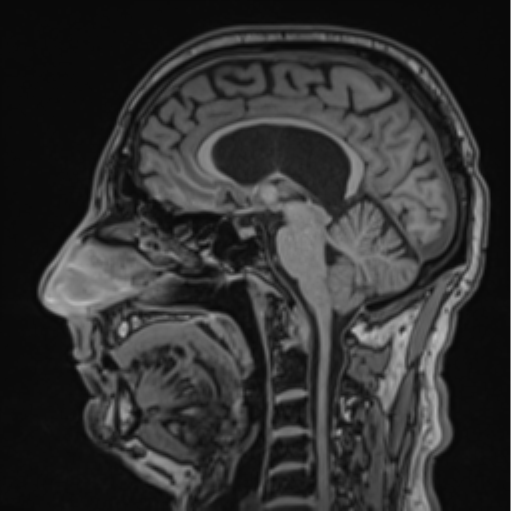 File:Colloid cyst of the third ventricle (Radiopaedia 86571-102662 Sagittal T1 41).png