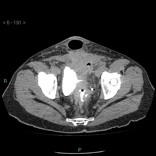 Colo-cutaneous fistula (Radiopaedia 40531-43129 A 80).jpg