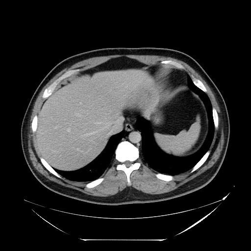 File:Colocolic intussusception due to lipoma (Radiopaedia 73712-84508 Axial 37).jpg