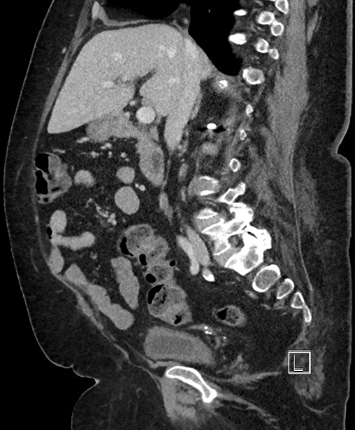 Colon adenocarcinoma (Radiopaedia 59374-66735 C 41).jpg