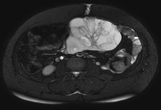 File:Colon adenocarcinoma with Krukenberg tumors, advanced pregnancy (Radiopaedia 67279-76645 Axial T2 SPAIR 40).jpg