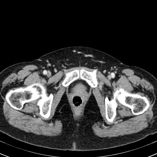 Colon carcinoma with hepatic metastases (Radiopaedia 29477-29961 A 116).jpg
