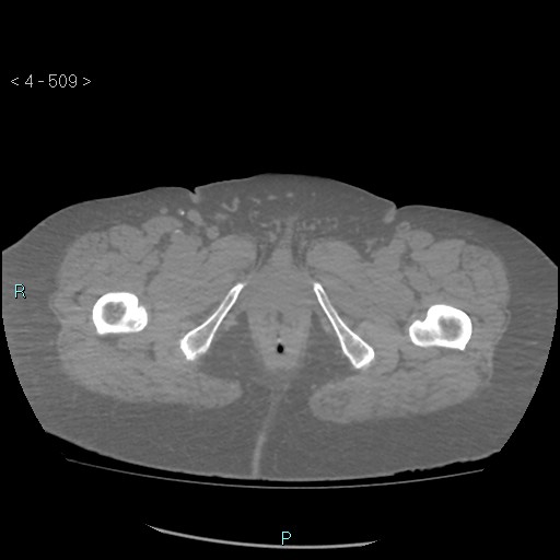 Colonic lipomas (Radiopaedia 49137-54244 Axial bone window 227).jpg
