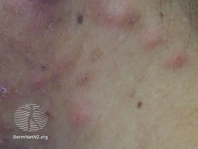 File:Eosinophilic folliculitis (DermNet NZ acne-eos-folliculitis2).jpg