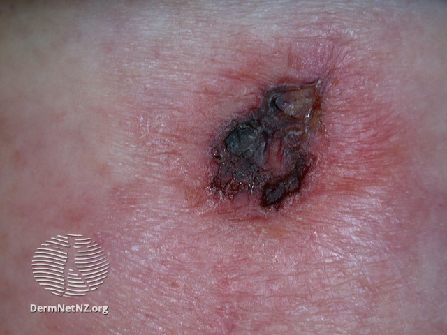 File:Intraepidermal carcinoma (DermNet NZ lesions-scc-in-situ-2931).jpg