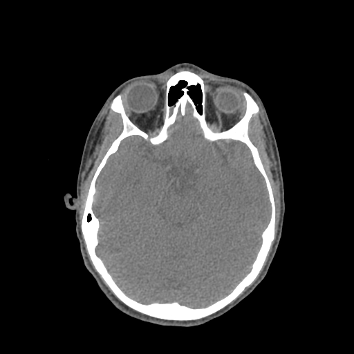 Nasal pyogenic granuloma (lobular capillary hemangioma) (Radiopaedia 85536-101244 Axial non-contrast 109).jpg