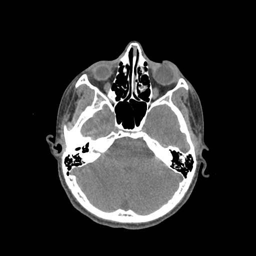 File:Nasal pyogenic granuloma (lobular capillary hemangioma) (Radiopaedia 85536-101244 Axial non-contrast 89).jpg