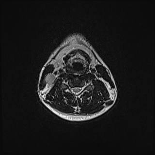 Nasopharyngeal carcinoma with perineural spread (Radiopaedia 55030-61380 Axial T2 57).jpg