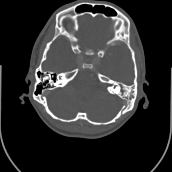 Nasopharyngeal carcinoma with skull base invasion (Radiopaedia 53415-59705 Axial bone window 7).jpg