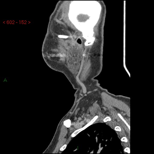 File:Nasopharyngeal lymphoma (Radiopaedia 54235-60433 B 50).jpg