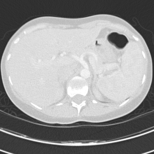 Necrobiotic pulmonary nodules - Crohn disease (Radiopaedia 20723-20631 Axial lung window 139).jpg