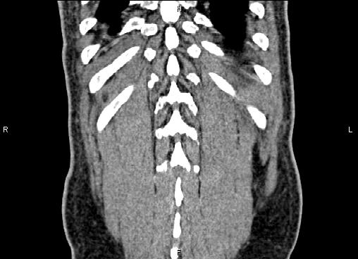 Necrotizing pancreatitis (Radiopaedia 87796-104248 F 62).jpg