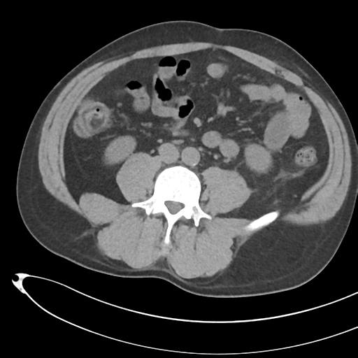 File:Necrotizing pancreatitis with acute necrotic collections (Radiopaedia 38829-41012 Axial non-contrast 48).png