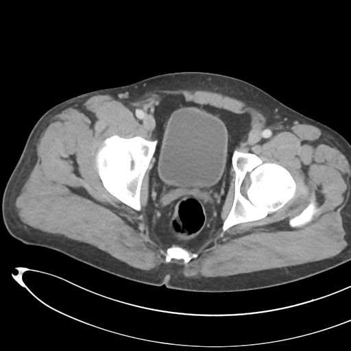 File:Necrotizing pancreatitis with acute necrotic collections (Radiopaedia 38829-41012 B 79).png