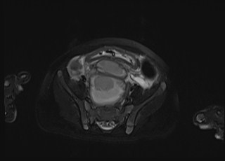 Neonatal prostatic utricle abscess - cyst (Radiopaedia 69511-79394 Axial T2 fat sat 26).jpg