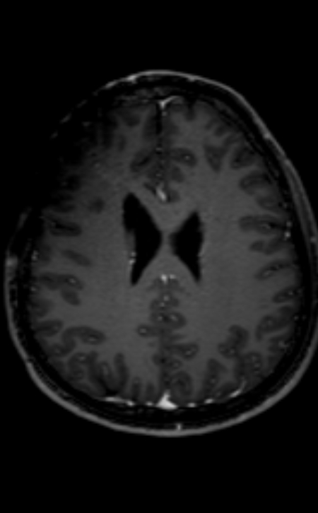 Neuro-Behçet disease (Radiopaedia 90112-107294 Axial T1 C+ 102).jpg