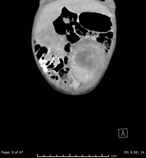 File:Neuroblastoma (Radiopaedia 41472-44355 B 8).jpg