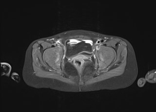 File:Neuroblastoma with bone metastases (Radiopaedia 67080-76414 Axial T1 C+ fat sat 49).jpg