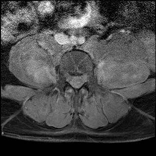 File:Neurofibromatosis type 1- extensive spinal involvement and Christmas tree sign (Radiopaedia 60610-68332 Axial T1 C+ fat sat 51).jpg