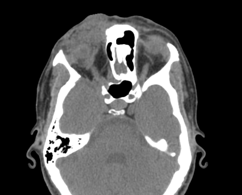 Neurofibromatosis type 1- orbital manifestations (Radiopaedia 49391-54511 Axial non-contrast 54).jpg