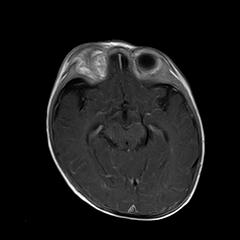 File:Neurofibromatosis type 1 (Radiopaedia 30089-30671 Axial T1 C+ 10).jpg